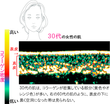 図)30代の女性の肌 30代の肌はコラーゲンが密集している部分(黄色やオレンジ色)が多い。右の60代の肌のように、表皮の下に黒く空洞になった帯は見られない。