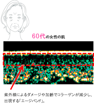図)60代の女性の肌 紫外線によるダメージや加齢でコラーゲンが減少し、出現する「エージバンド」。
