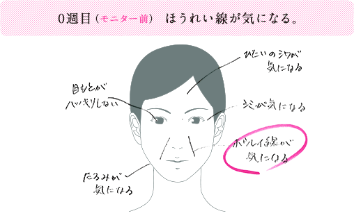 0週目（モニター前）ほうれい線が気になる。