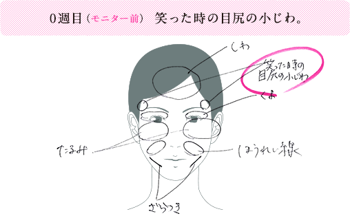 0週目（モニター前）笑った時の目尻の小じわ。