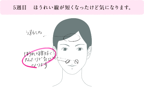 5週目 ほうれい線が短くなったけど気になります。