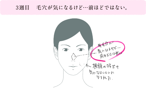 3週目 毛穴が気になるけど・・・前ほどではない。
